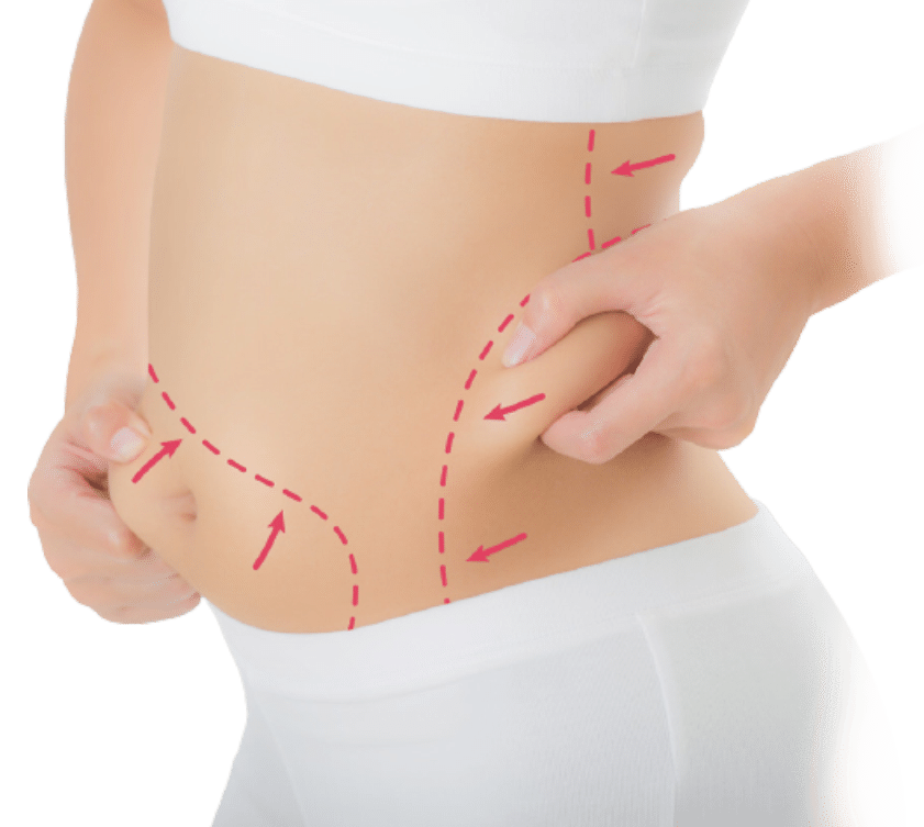 Liposuction surgery